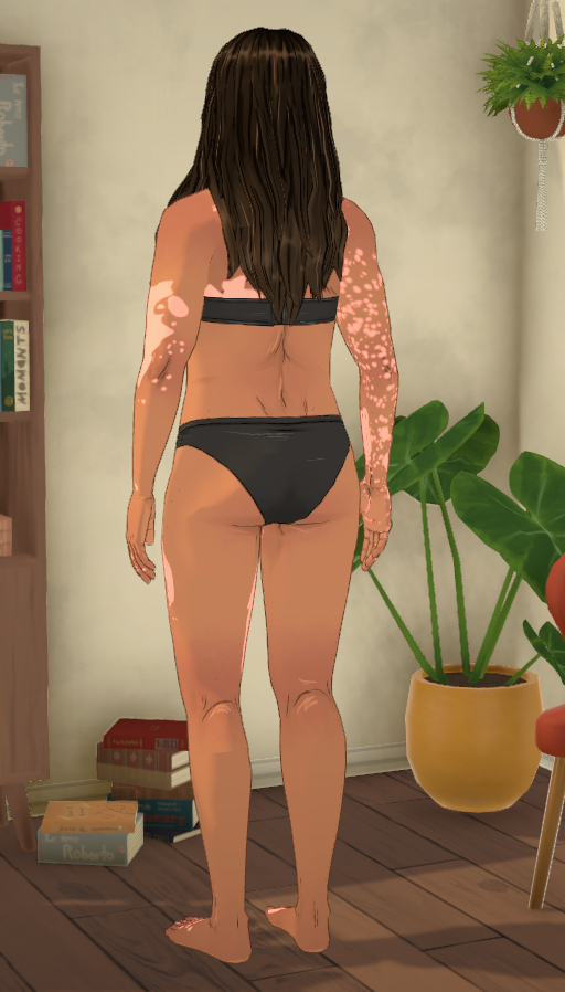 Vitiligo [Rikalix] image 4