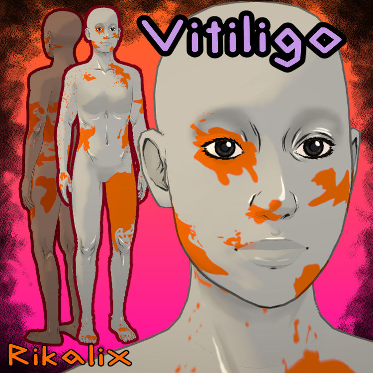 Vitiligo [Rikalix]